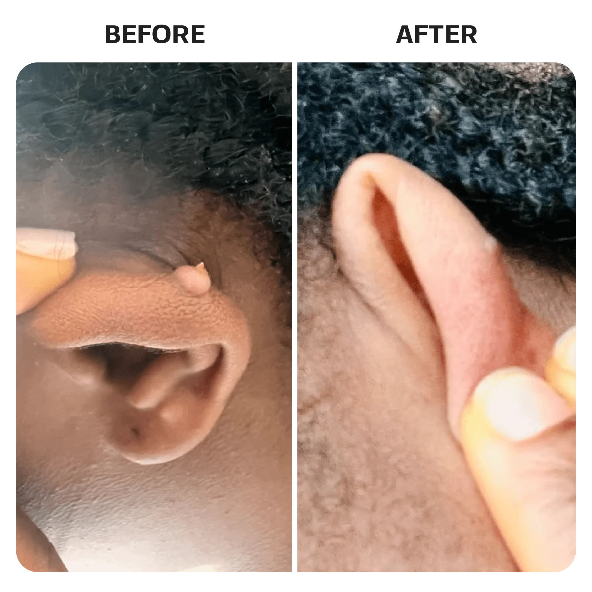 Keloid Bump Removal Gel Swabs - Image 10