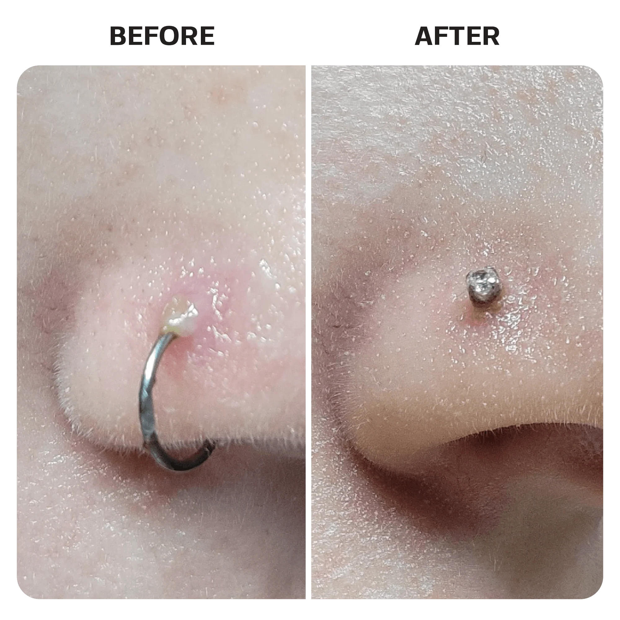 Keloid Bump Removal Gel Swabs - Image 11