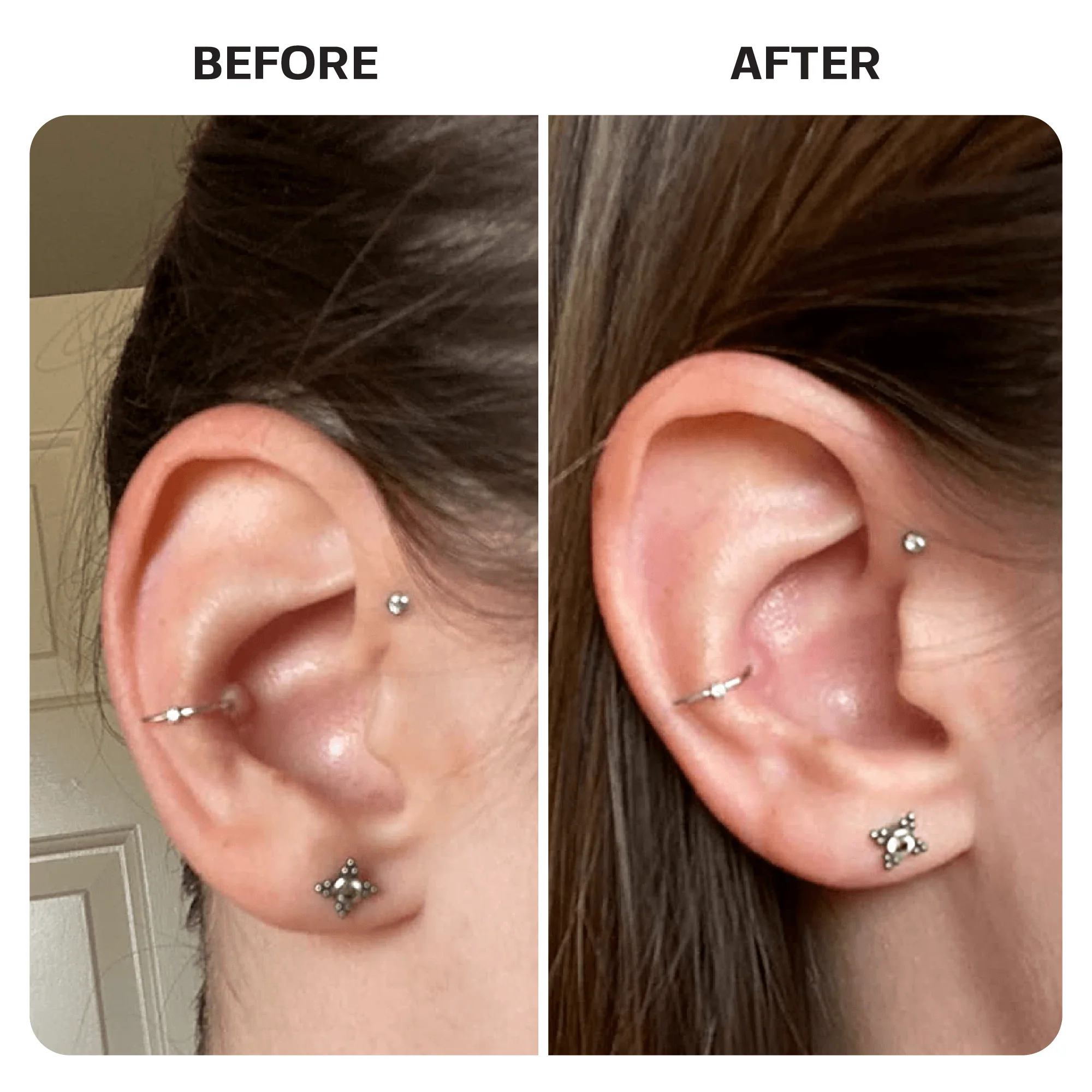 Keloid Bump Removal Gel Swabs - Image 8