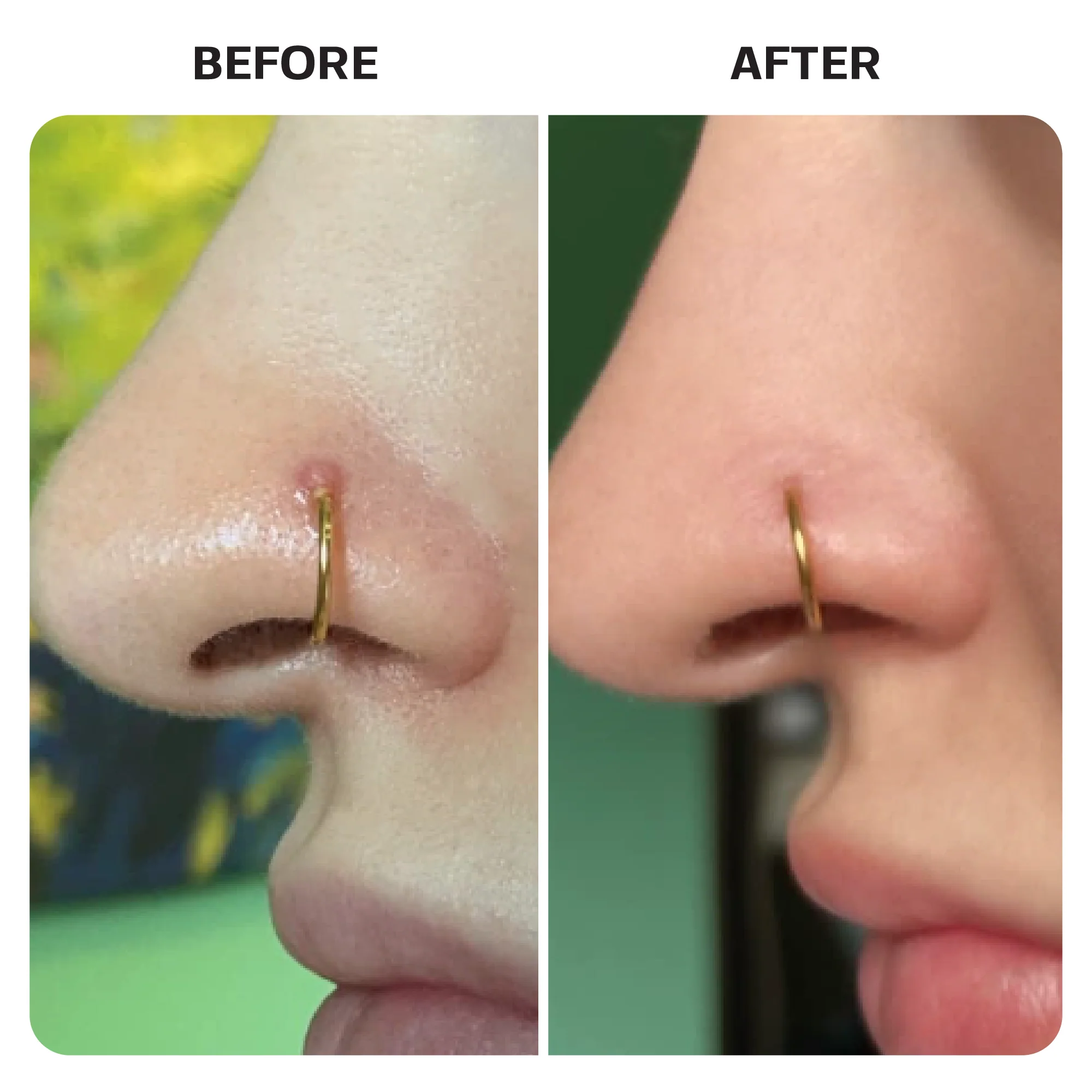 Keloid Bump Removal Gel Swabs - Image 9