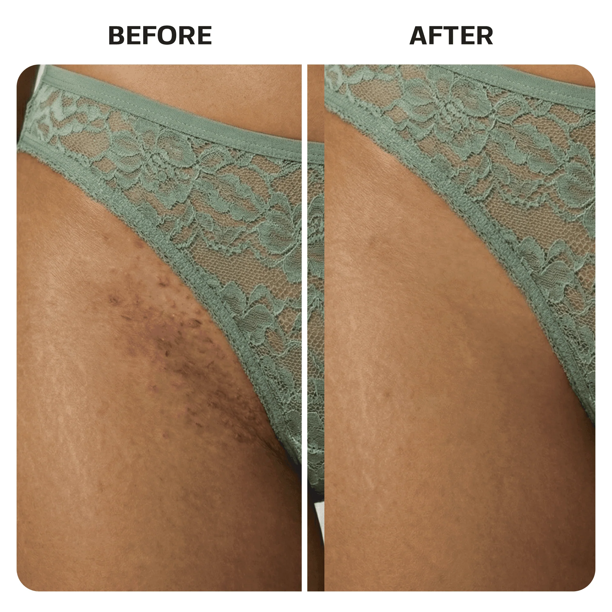 Ingrown Hair Treatment Oil - Image 8