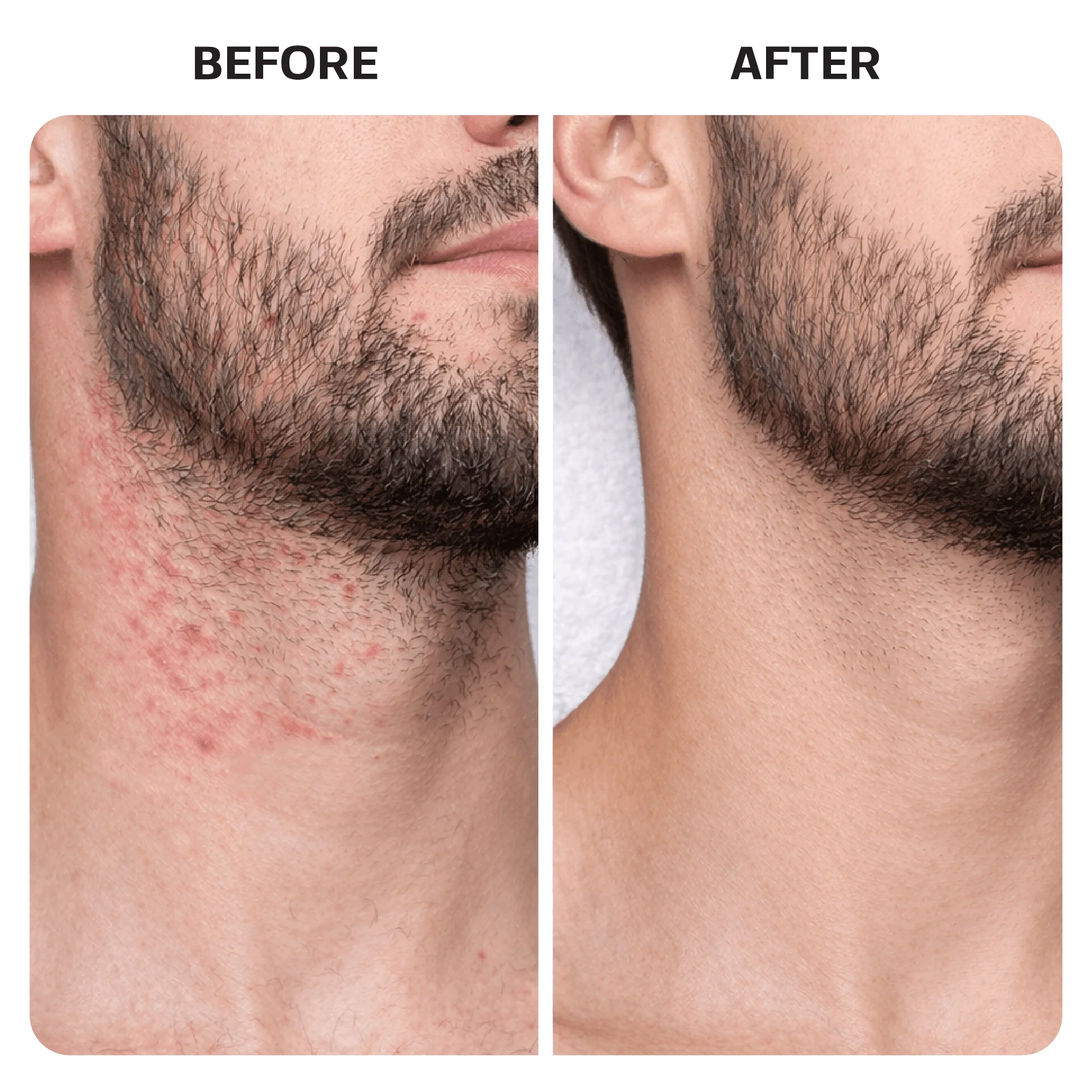 Ingrown Hair Treatment Pads - Image 8
