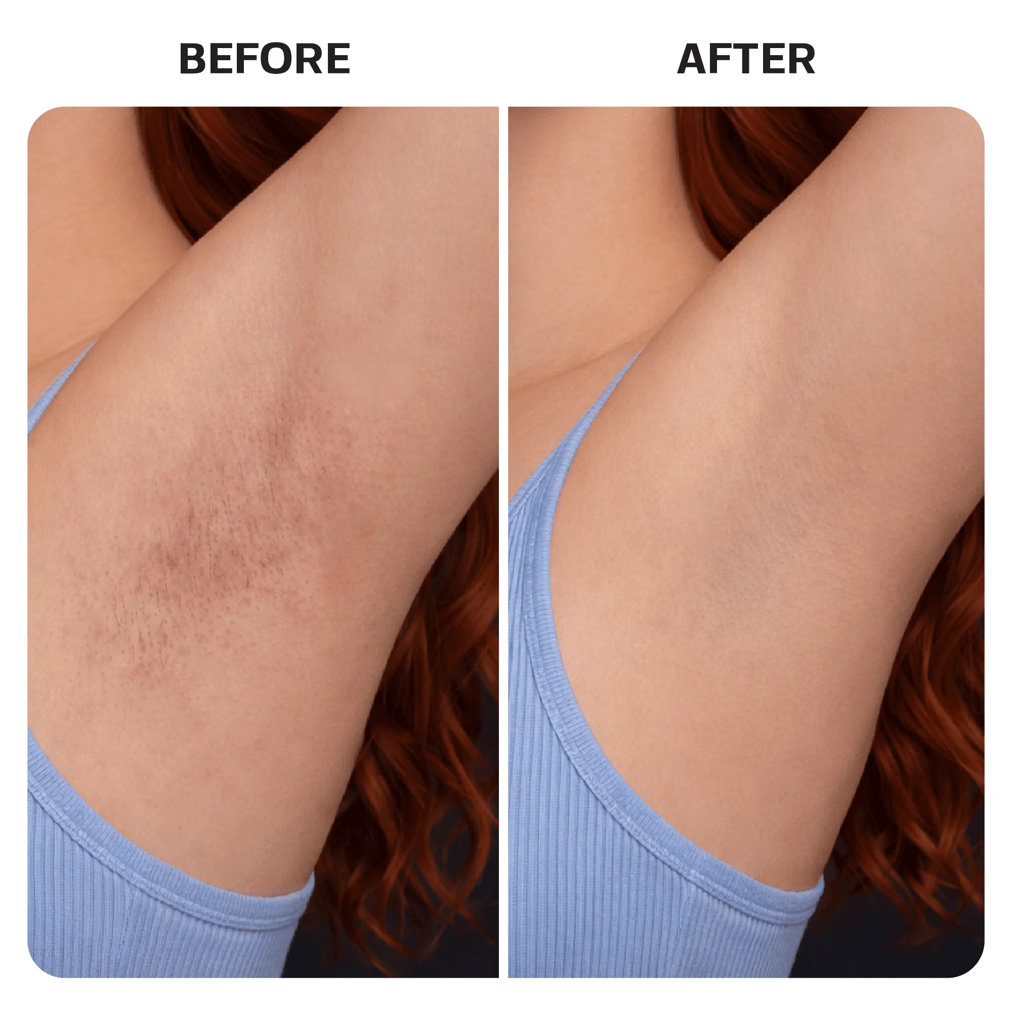 Ingrown Hair Treatment Pads - Image 9