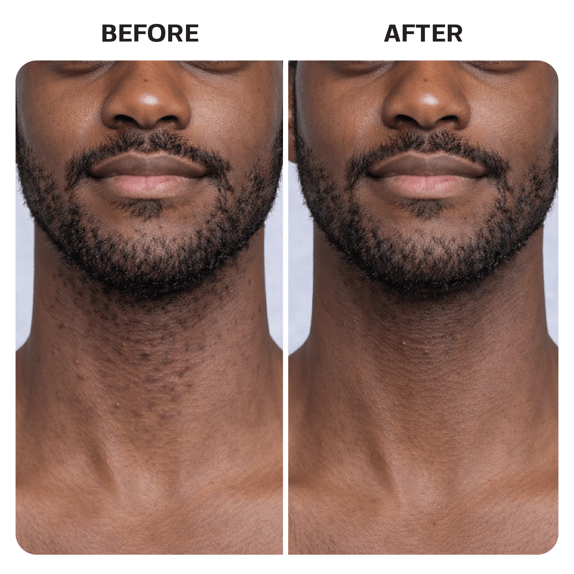 Ingrown Hair Roller Serum - Image 9