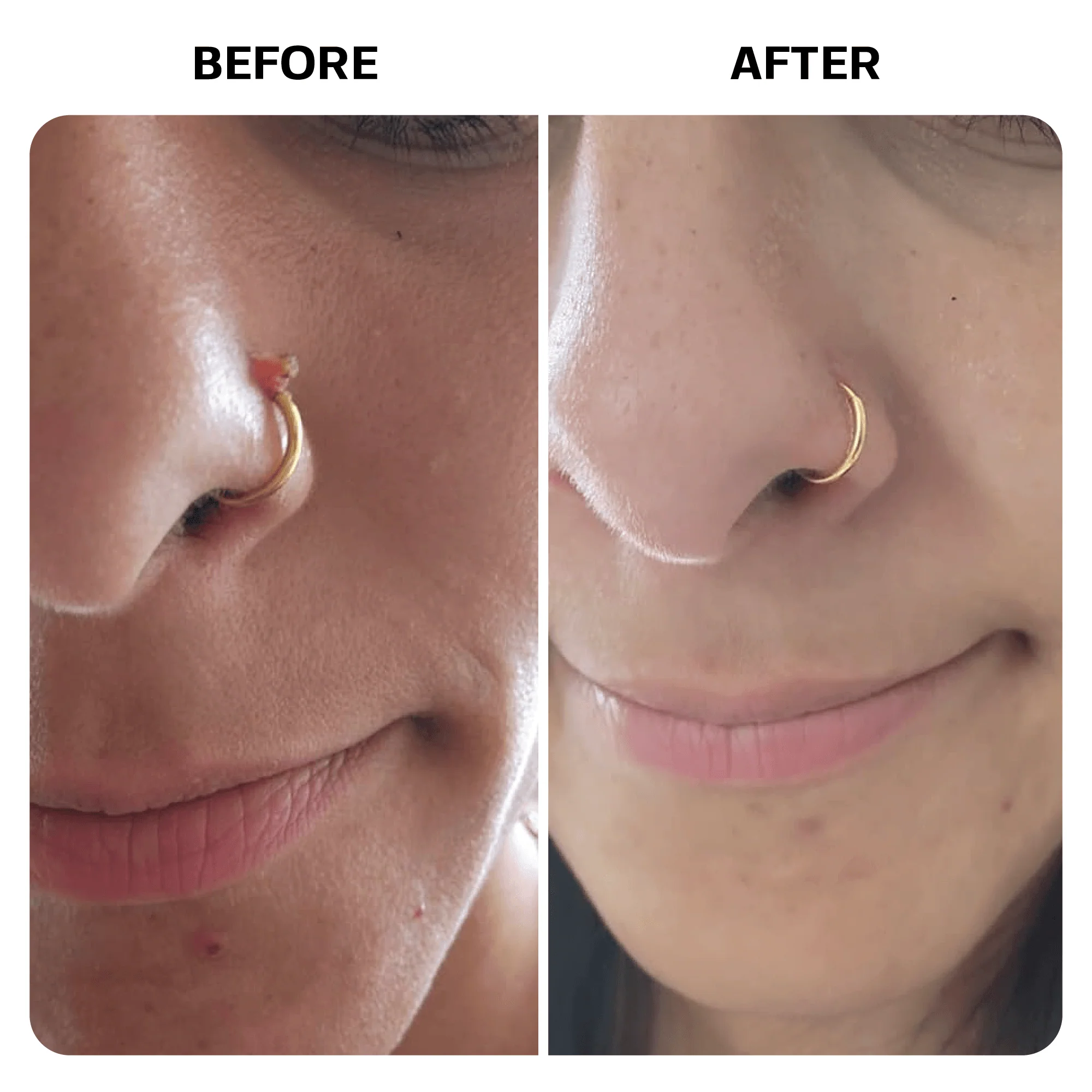 Keloid Bump Removal Gel - Image 10