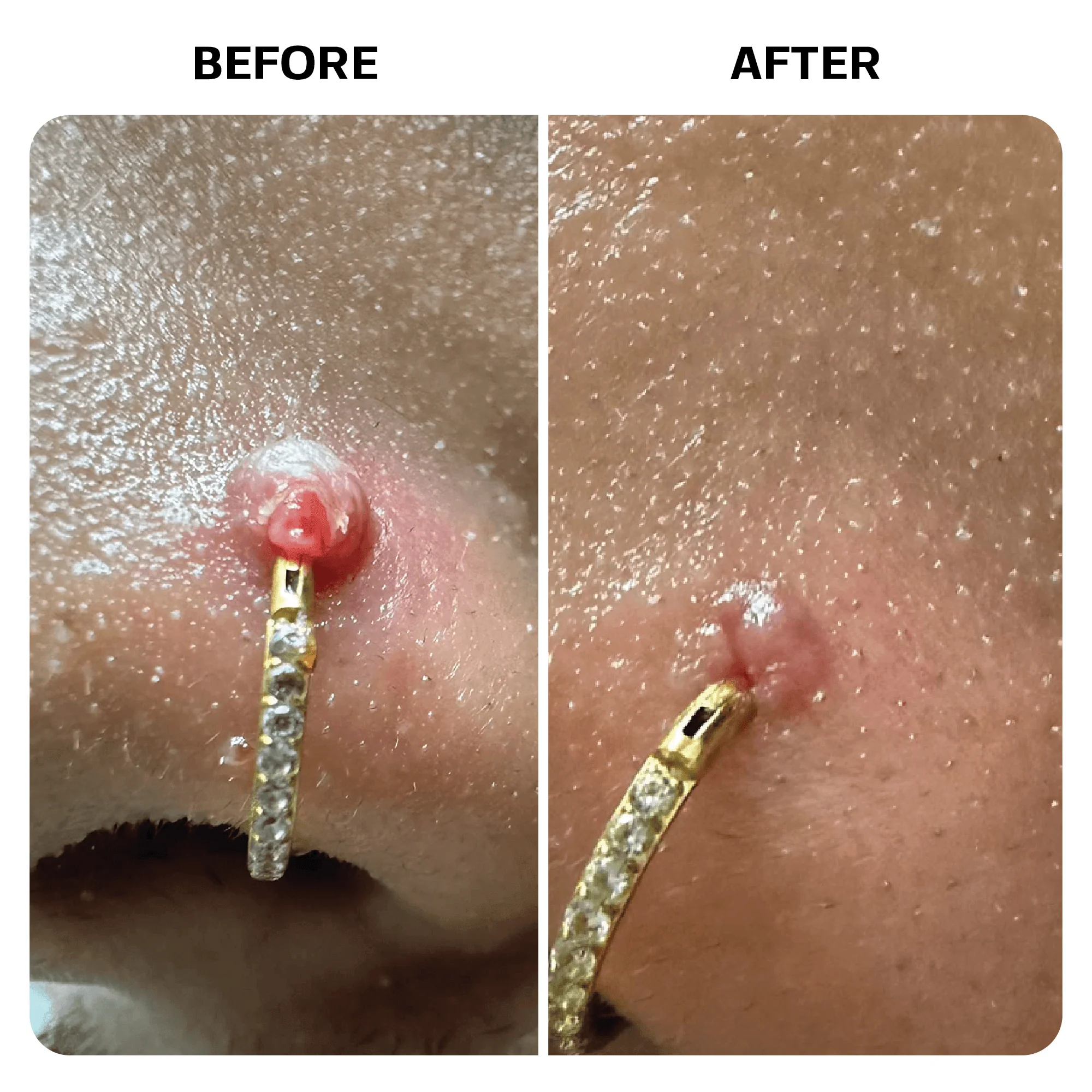 Keloid Bump Removal Gel - Image 9